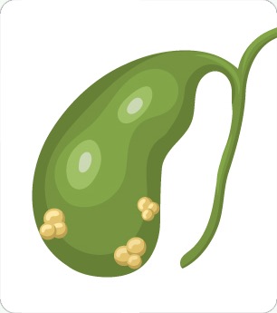 담낭 안에 돌이 생긴 담석증 그림