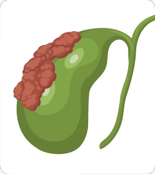담낭에 생긴 악성 종양 담낭암 그림